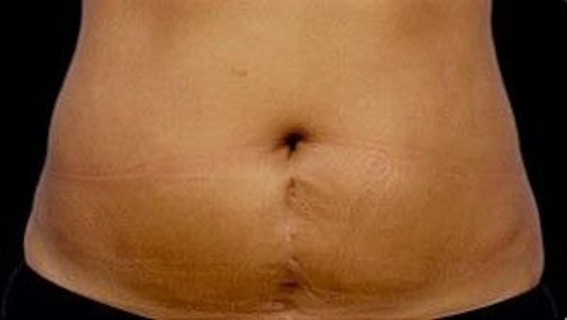 CoolSculpting Before & After Gallery - Patient 55344860 - Image 2