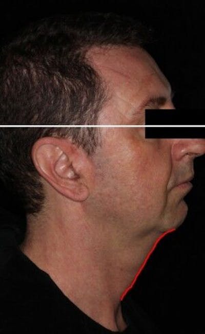 Infini Genius Before & After Gallery - Patient 55344859 - Image 1