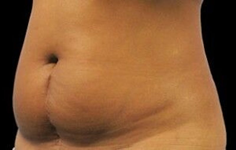 CoolSculpting Before & After Gallery - Patient 55344860 - Image 3