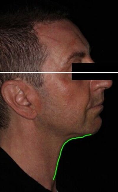 Infini Genius Before & After Gallery - Patient 55344859 - Image 2