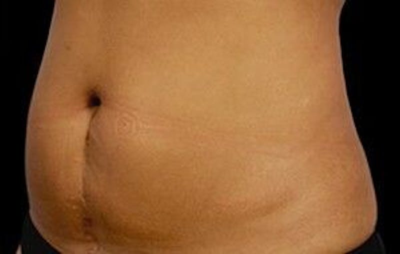 CoolSculpting Before & After Gallery - Patient 55344860 - Image 4