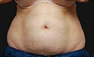 CoolSculpting Before & After Gallery - Patient 55344861 - Image 1