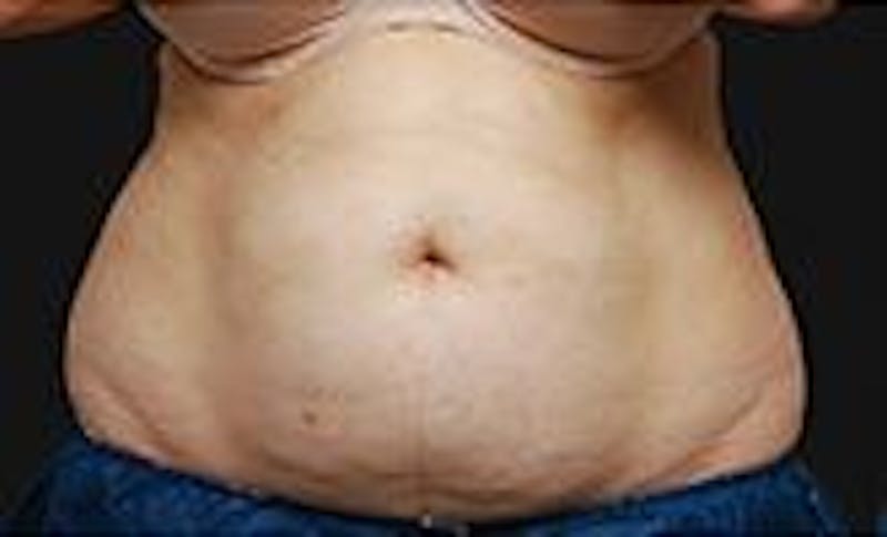 CoolSculpting Before & After Gallery - Patient 55344861 - Image 1