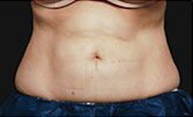 CoolSculpting Before & After Gallery - Patient 55344861 - Image 2