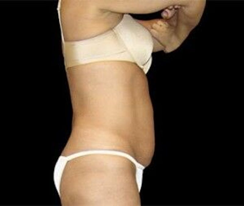 CoolSculpting Before & After Gallery - Patient 55344863 - Image 2