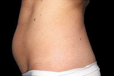 CoolSculpting Before & After Gallery - Patient 55344864 - Image 1