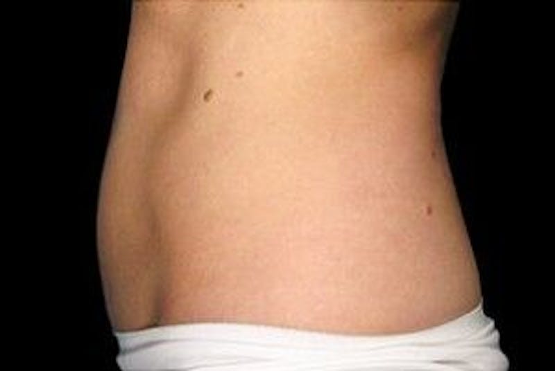 CoolSculpting Before & After Gallery - Patient 55344864 - Image 2
