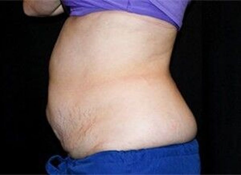 CoolSculpting Before & After Gallery - Patient 55344866 - Image 1