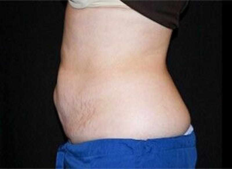 CoolSculpting Gallery - Patient 55344866 - Image 2