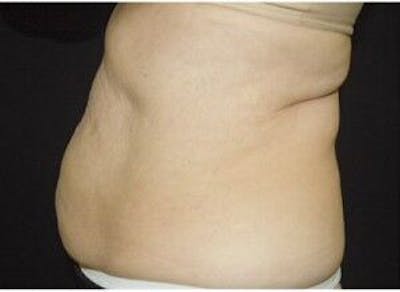 CoolSculpting Before & After Gallery - Patient 55344867 - Image 1