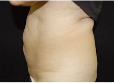 CoolSculpting Before & After Gallery - Patient 55344867 - Image 2