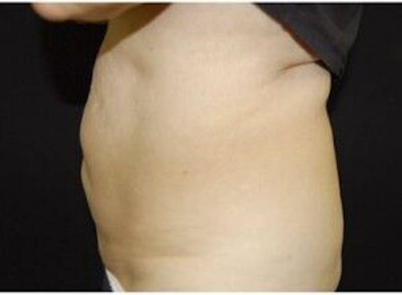 CoolSculpting Before & After Gallery - Patient 55344867 - Image 2