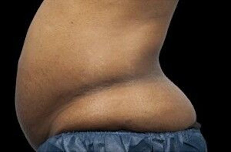 CoolSculpting Before & After Gallery - Patient 55344871 - Image 1