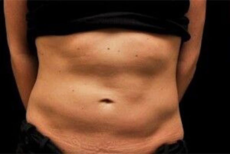 CoolSculpting Before & After Gallery - Patient 55344874 - Image 1