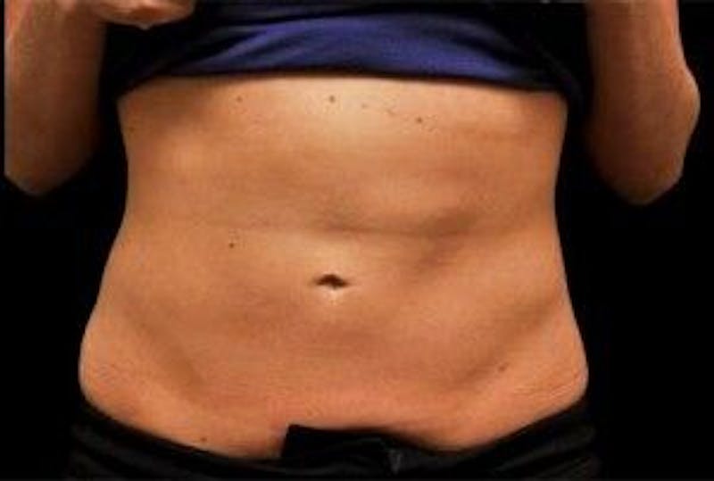 CoolSculpting Before & After Gallery - Patient 55344874 - Image 2