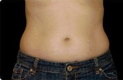 CoolSculpting Before & After Gallery - Patient 55344875 - Image 1