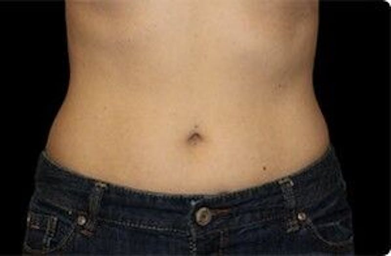 CoolSculpting Before & After Gallery - Patient 55344875 - Image 2