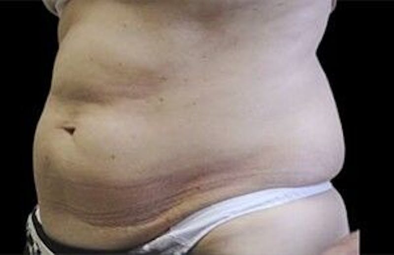 CoolSculpting Before & After Gallery - Patient 55344877 - Image 1