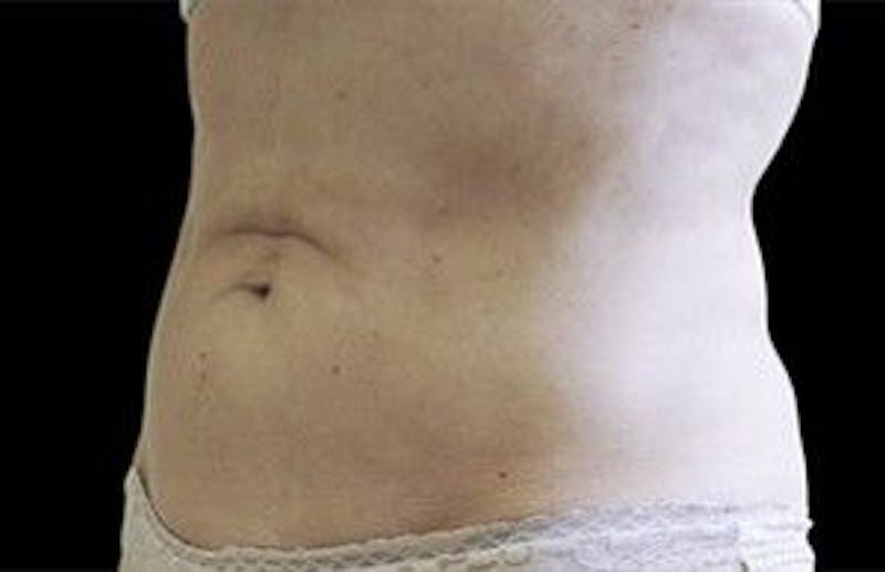 CoolSculpting Before & After Gallery - Patient 55344877 - Image 2