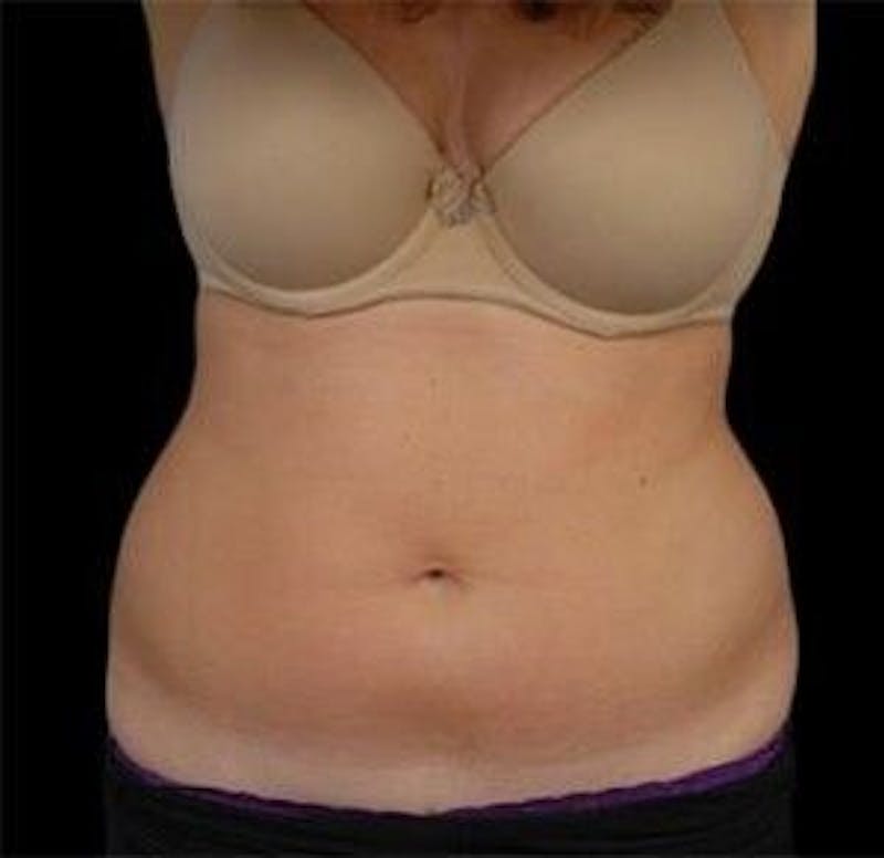 CoolSculpting Before & After Gallery - Patient 55344881 - Image 1