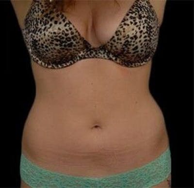 CoolSculpting Before & After Gallery - Patient 55344881 - Image 2