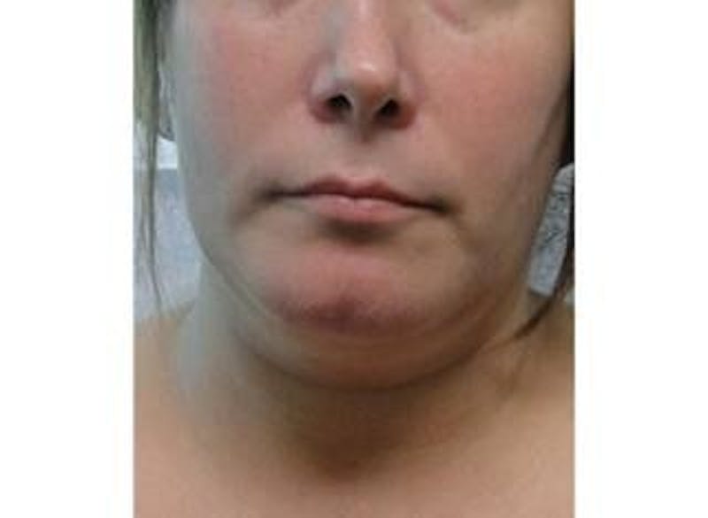 Infini Genius Before & After Gallery - Patient 55344885 - Image 1