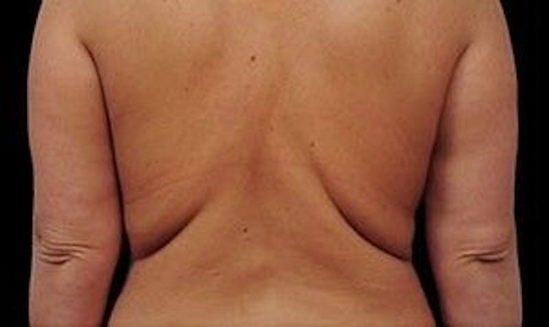CoolSculpting Before & After Gallery - Patient 55344886 - Image 1