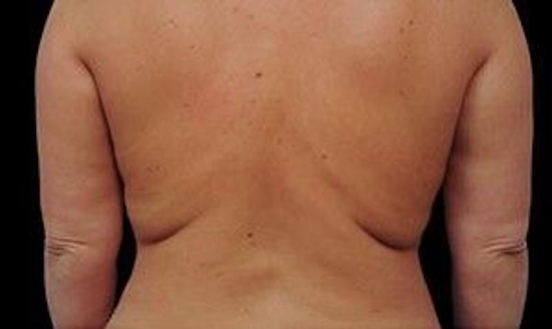 CoolSculpting Before & After Gallery - Patient 55344886 - Image 2