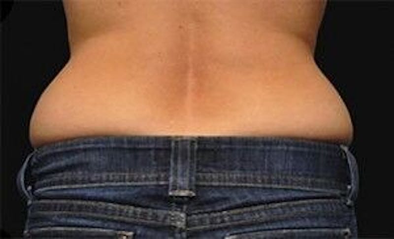 CoolSculpting Before & After Gallery - Patient 55344890 - Image 1