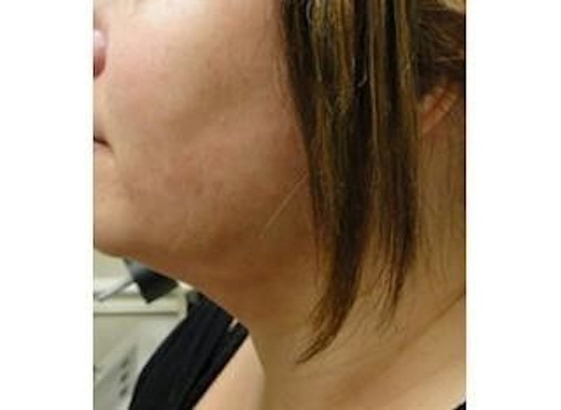 Infini Genius Before & After Gallery - Patient 55344889 - Image 2