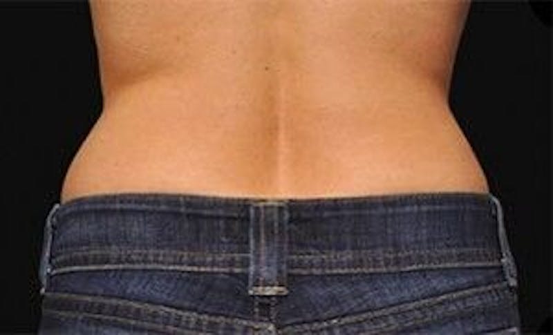 CoolSculpting Before & After Gallery - Patient 55344890 - Image 2