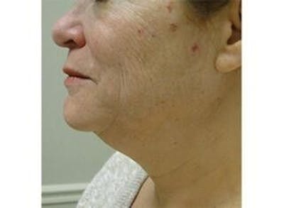 Infini Genius Before & After Gallery - Patient 55344891 - Image 1