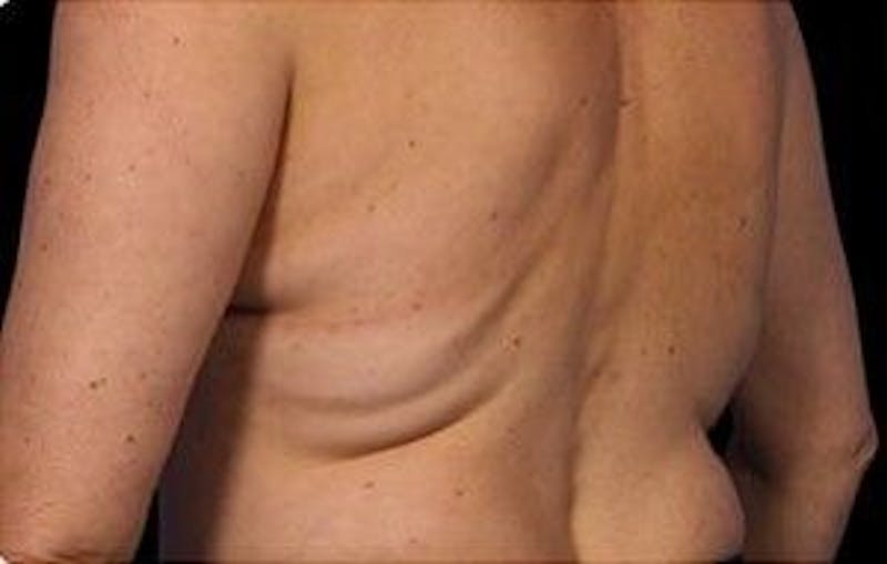 CoolSculpting Before & After Gallery - Patient 55344892 - Image 1