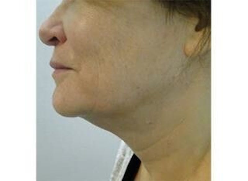 Infini Genius Before & After Gallery - Patient 55344891 - Image 2