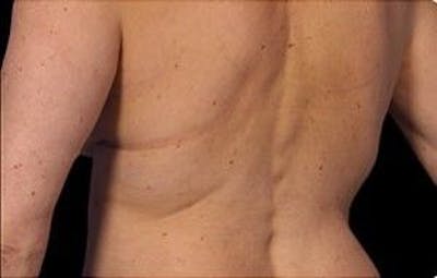 CoolSculpting Before & After Gallery - Patient 55344892 - Image 2