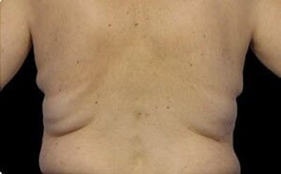 CoolSculpting Before & After Gallery - Patient 55344896 - Image 1