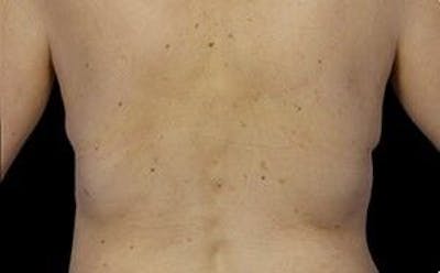 CoolSculpting Before & After Gallery - Patient 55344896 - Image 2