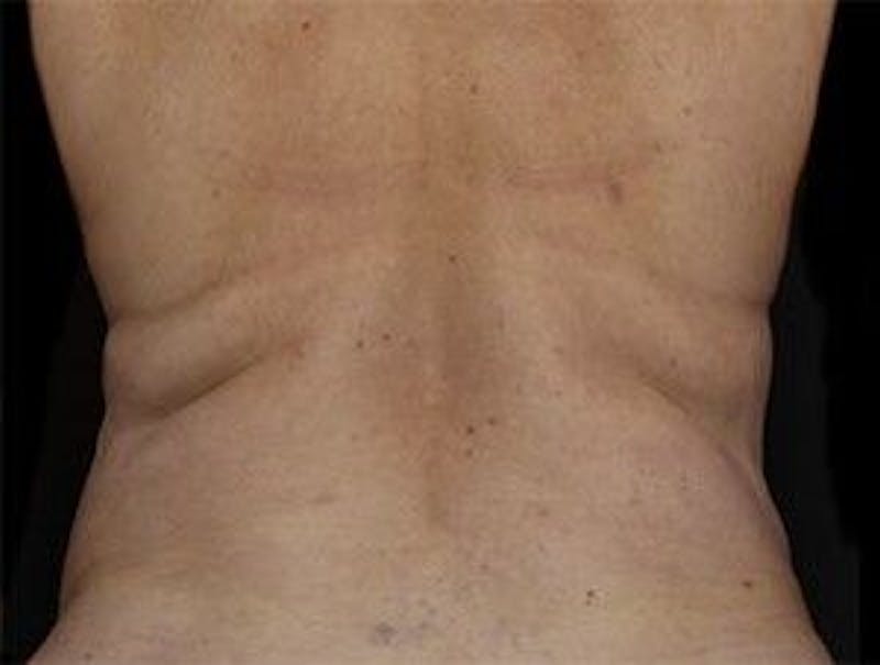 CoolSculpting Gallery - Patient 55344898 - Image 1