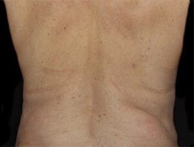 CoolSculpting Before & After Gallery - Patient 55344898 - Image 2