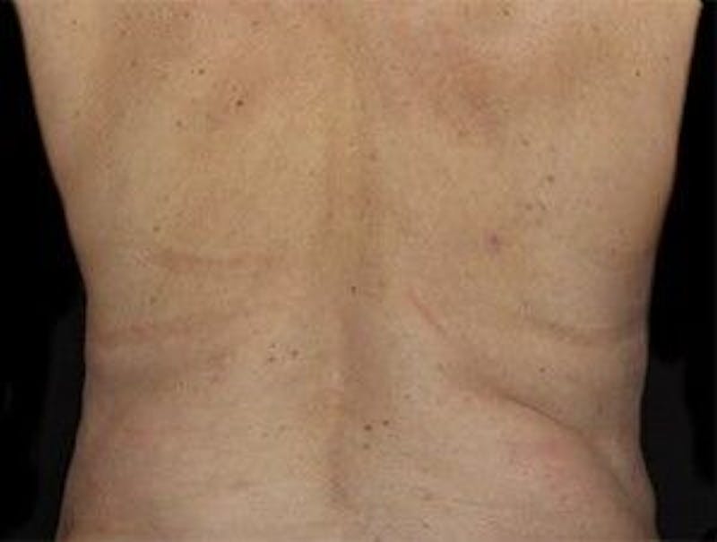 CoolSculpting Before & After Gallery - Patient 55344898 - Image 2