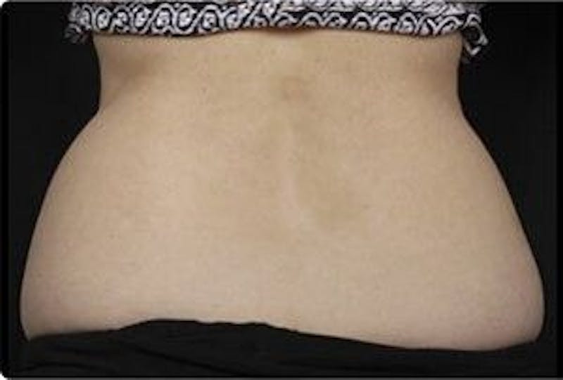 CoolSculpting Before & After Gallery - Patient 55344900 - Image 1