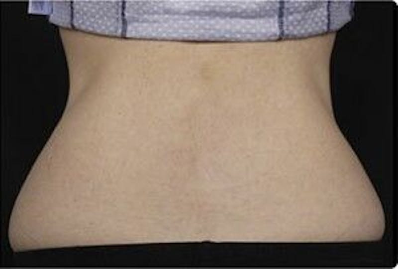 CoolSculpting Before & After Gallery - Patient 55344900 - Image 2