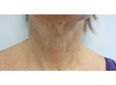 Infini Genius Before & After Gallery - Patient 55344901 - Image 1