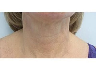 Infini Genius Before & After Gallery - Patient 55344901 - Image 2