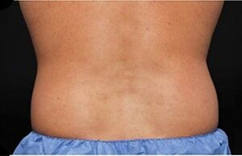 CoolSculpting Before & After Gallery - Patient 55344902 - Image 1