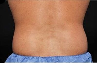 CoolSculpting Before & After Gallery - Patient 55344902 - Image 1