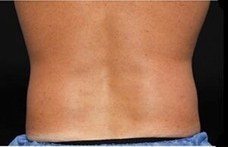 CoolSculpting Before & After Gallery - Patient 55344902 - Image 2