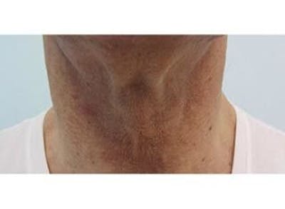 Infini Genius Before & After Gallery - Patient 55344903 - Image 1