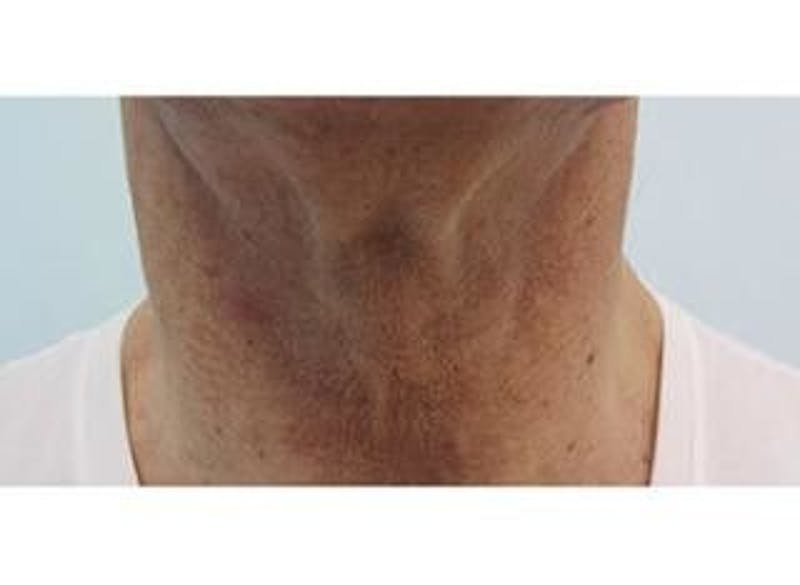 Infini Genius Before & After Gallery - Patient 55344903 - Image 1