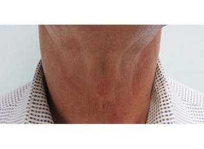 Infini Genius Before & After Gallery - Patient 55344903 - Image 2